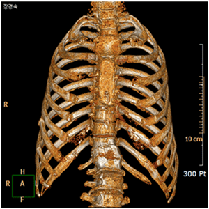 늑골 골정의 3D-CT