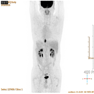 식도암 환자의 PET-CT