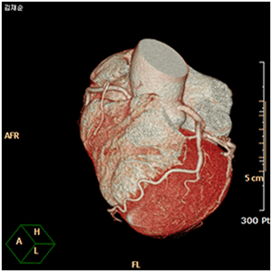 관상동맥 환자의 3D-CT