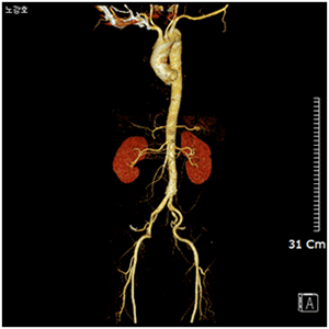 대동맥 환자의 3D-CT